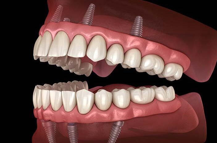 Dentures Implants Near You
