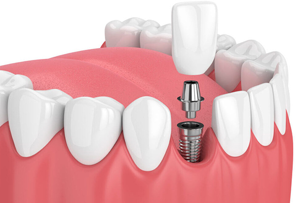 Dental implants near you