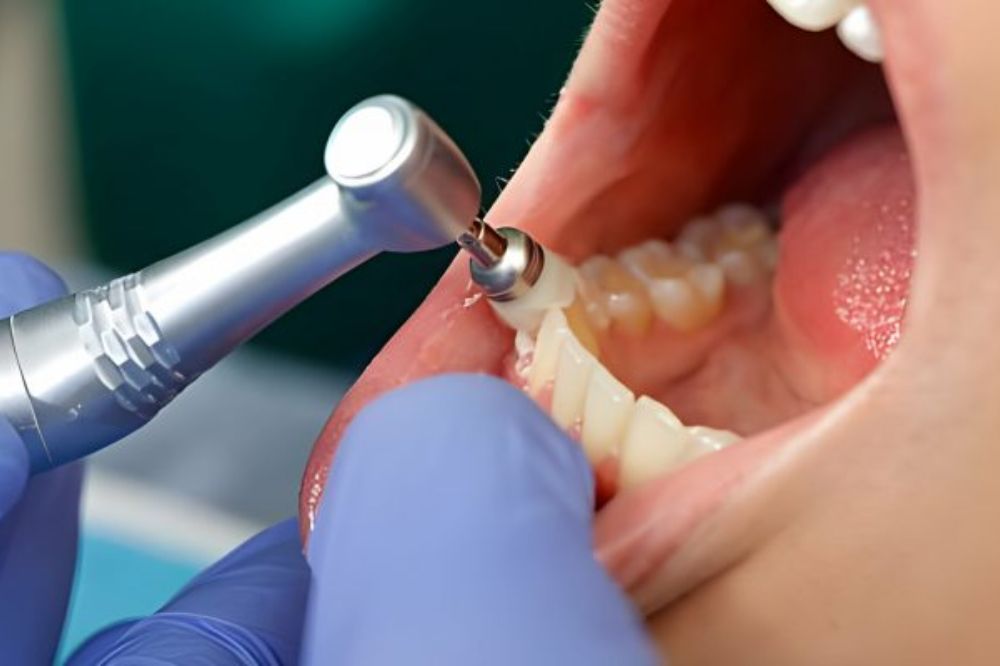 The Step-by-Step Guide to What Happens During a Dental Cleaning