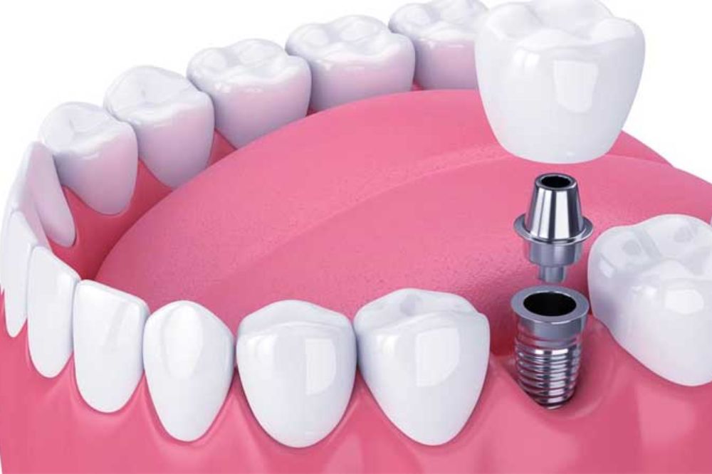Dental Implants near you