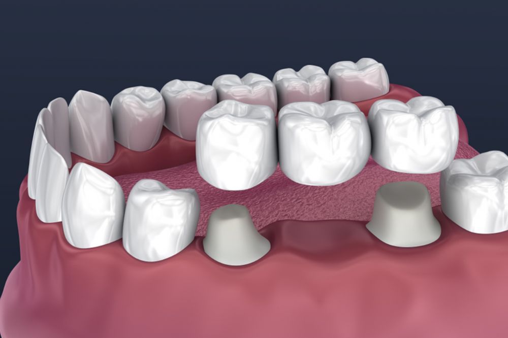 Is a Dental Bridge the Right Option for One Missing Tooth?
