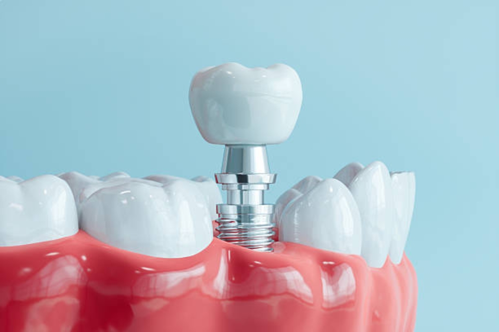 What Makes Dental Implants a Strong Tooth Replacement Option? Orlando Dentists Explain the Benefits