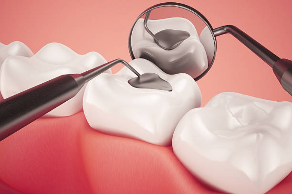 What to Expect During a Pain-Free Dental Filling Procedure