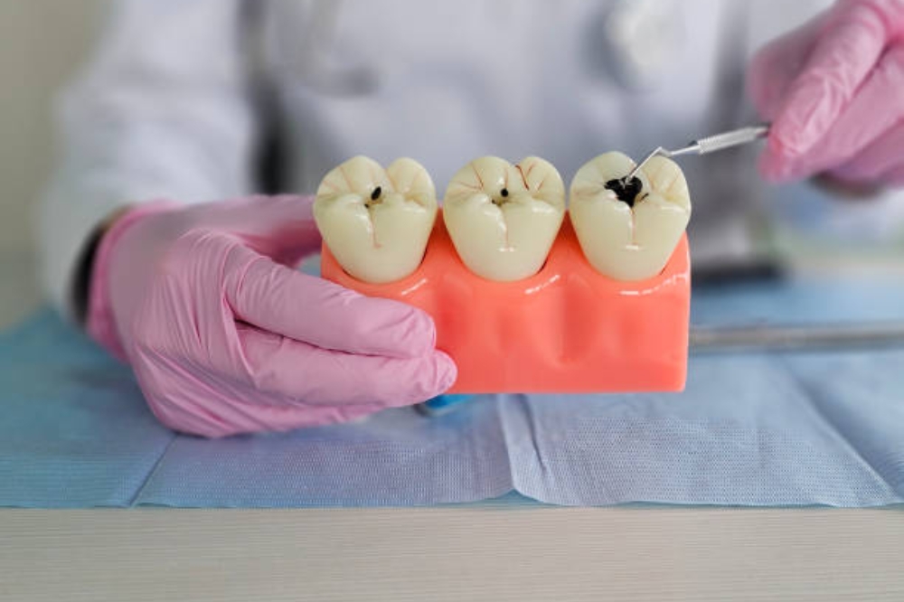 Dental Fillings Explained: Types, Materials & What Dentists Suggest