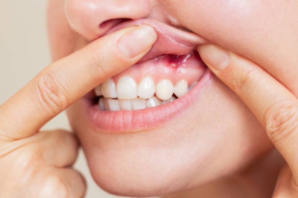 Gum Disease Symptoms: How to Spot Them Early and Prevent Further Damage
