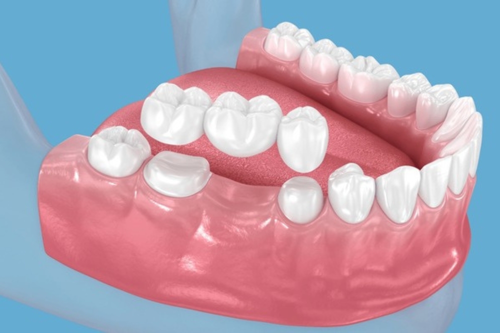 Dental Bridges Explained: How They Replace Missing Teeth Naturally