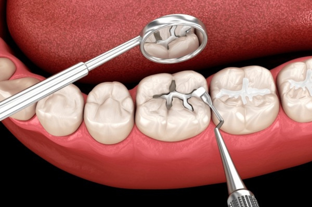 Dental Fillings Explained: When A Cavity Needs Treatment