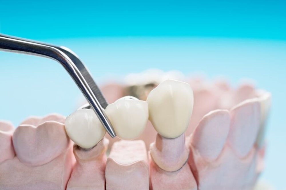 What Are Dental Bridges in 2026? A Modern Guide to Replacing Missing Teeth