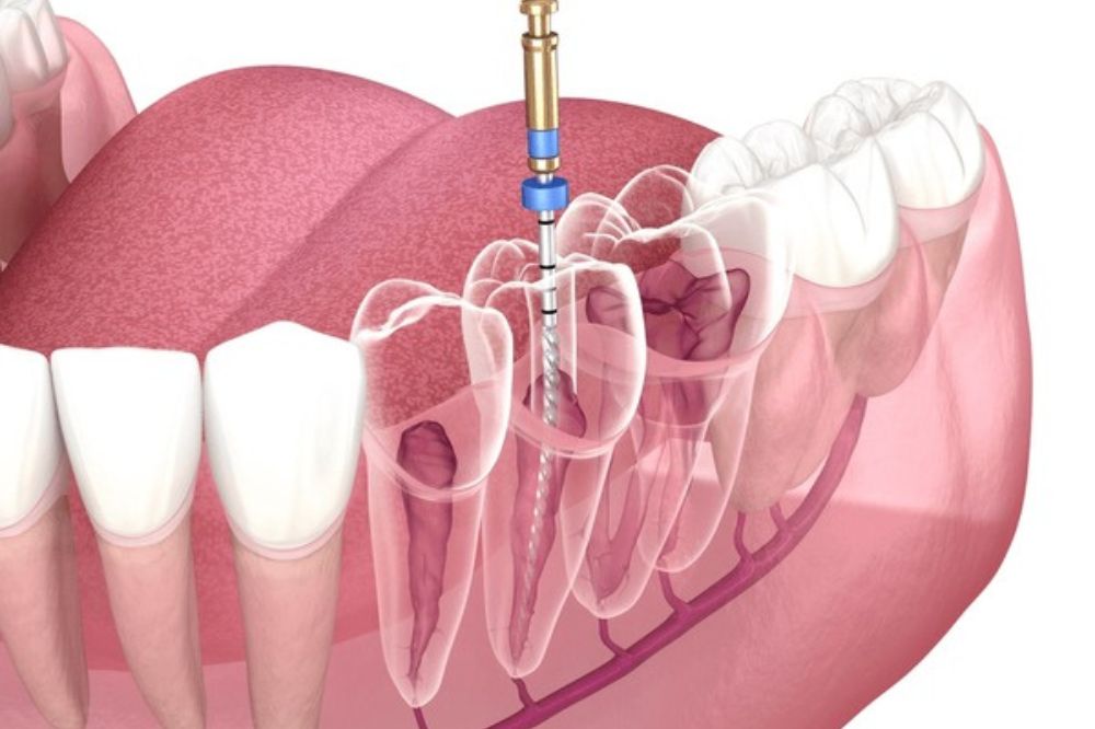 Severe Tooth Pain Keeping You Awake? How Root Canal Therapy Can Save Your Tooth